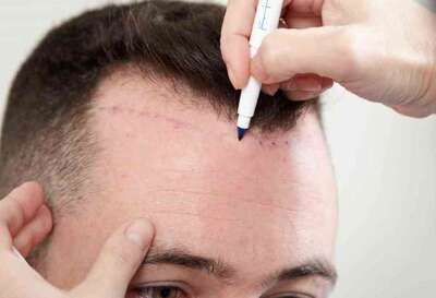 Affordable Hair Transplant Cost in Jaipur at AK Aesthetics